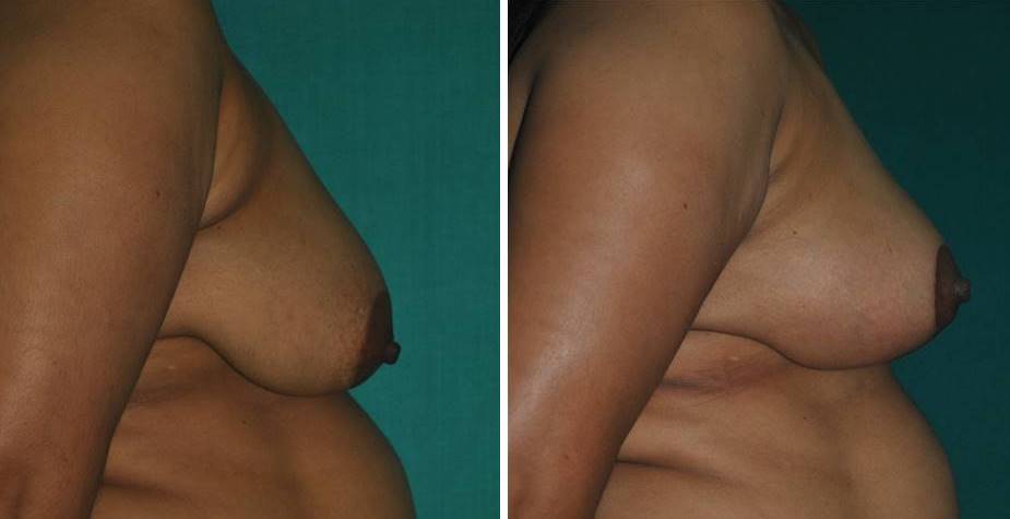 Breast-lift surgery in India